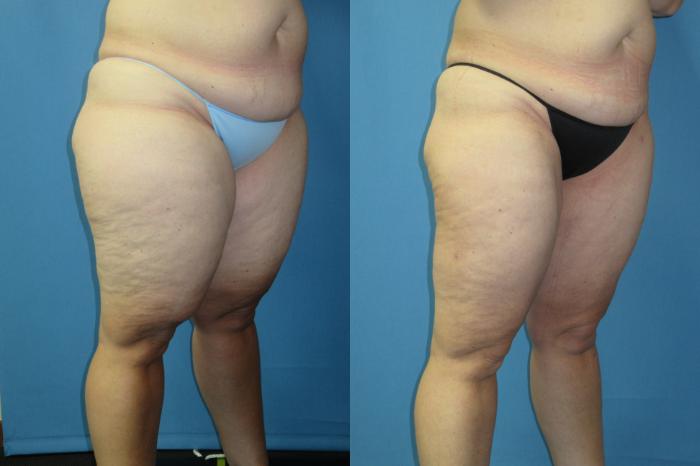 Before & After Liposuction - Inner and/or Outer Thighs Case 186 Right Oblique View in Coeur d'Alene, ID
