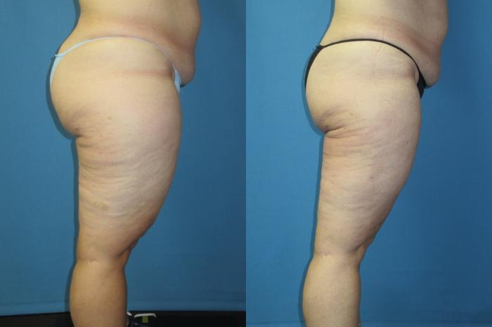 Before & After Liposuction - Inner and/or Outer Thighs Case 186 Right Side View in Coeur d'Alene, ID