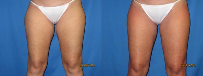Before & After Liposuction - Inner and/or Outer Thighs Case 22 View #1 View in Coeur d'Alene, ID