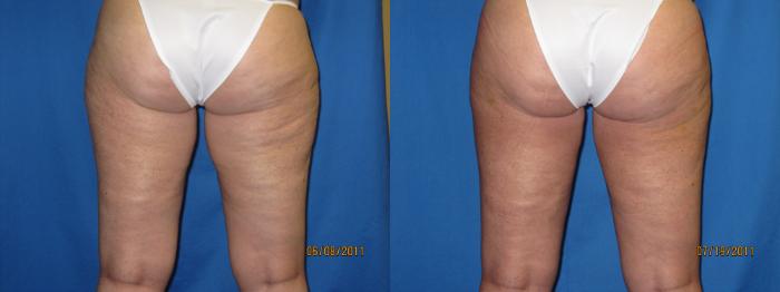 Before & After Liposuction - Inner and/or Outer Thighs Case 22 View #2 View in Coeur d'Alene, ID