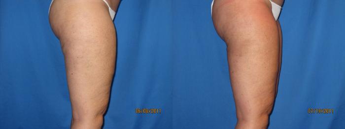 Before & After Liposuction - Inner and/or Outer Thighs Case 22 View #3 View in Coeur d'Alene, ID