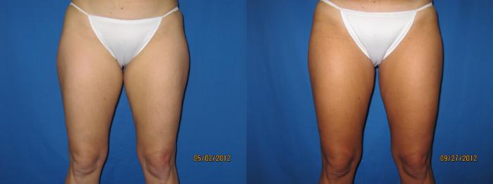 Before & After Liposuction - Inner and/or Outer Thighs Case 27 View #2 View in Coeur d'Alene, ID