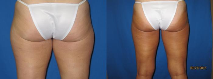 Before & After Liposuction - Inner and/or Outer Thighs Case 27 View #4 View in Coeur d'Alene, ID