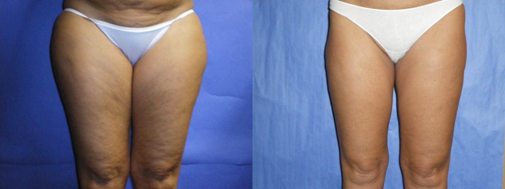 Before & After Liposuction - Inner and/or Outer Thighs Case 8 View #1 View in Coeur d'Alene, ID
