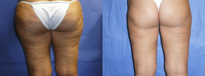 Before & After Liposuction - Inner and/or Outer Thighs Case 8 View #2 View in Coeur d'Alene, ID