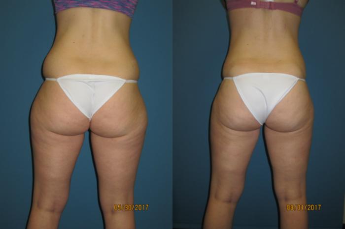 Visible scar tissue hard lump after inner thigh lipo 2 months ago? (Photos)