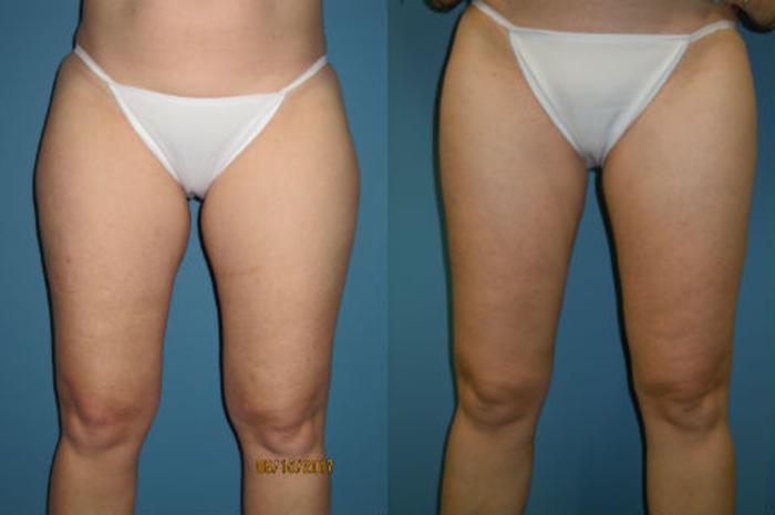 Case Study : Thigh Liposuction in Female