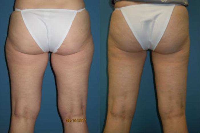 Before & After Liposuction - Inner and/or Outer Thighs Case 88 View #2 View in Coeur d'Alene, ID