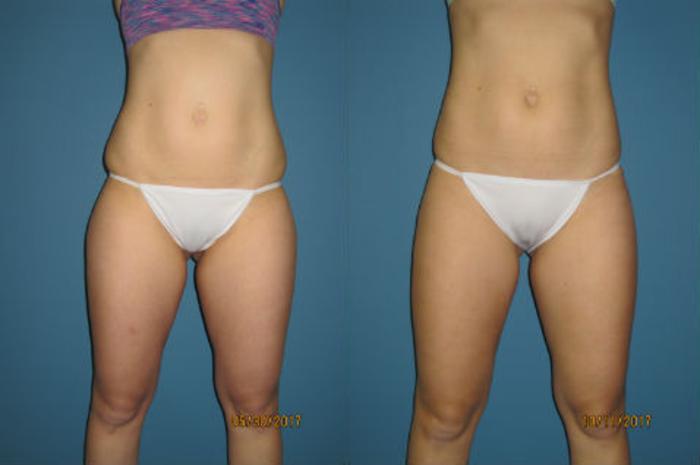 Before & After Liposuction - Abdomen / Flanks Case 90 View #1 View in Coeur d'Alene, ID