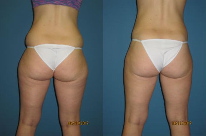 Before & After Liposuction - Abdomen / Flanks Case 90 View #2 View in Coeur d'Alene, ID