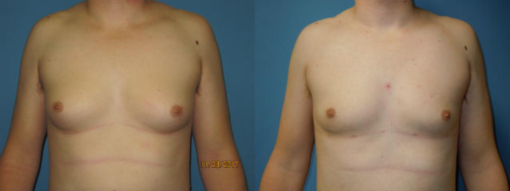 Before & After Liposuction - Male Chest Case 101 View #1 View in Coeur d'Alene, ID
