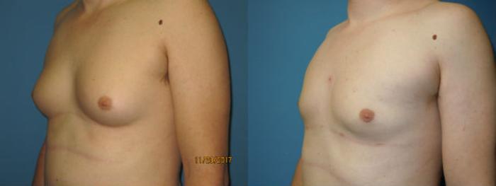Before & After Liposuction - Male Chest Case 101 View #2 View in Coeur d'Alene, ID