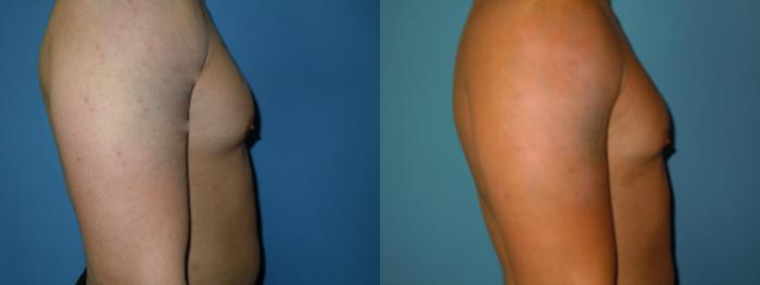Before & After Liposuction - Male Chest Case 138 View #2 View in Coeur d'Alene, ID