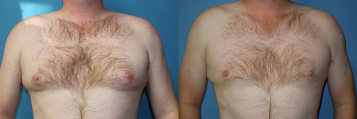 Before & After Liposuction - Male Chest Case 148 View #1 View in Coeur d'Alene, ID