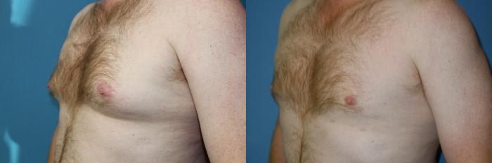 Before & After Liposuction - Male Chest Case 148 View #2 View in Coeur d'Alene, ID