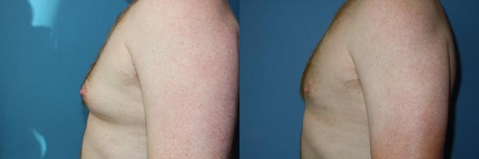 Before & After Liposuction - Male Chest Case 148 View #3 View in Coeur d'Alene, ID
