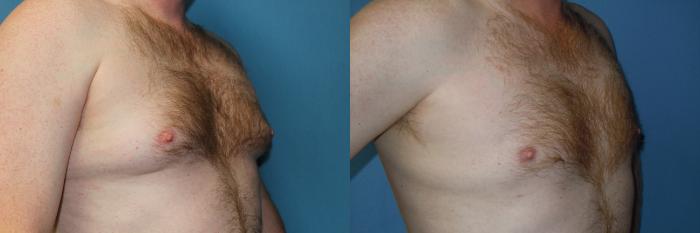 Before & After Liposuction - Male Chest Case 148 View #4 View in Coeur d'Alene, ID