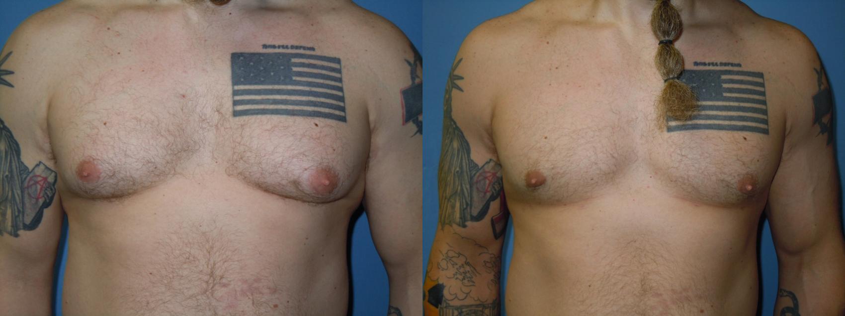 Before & After Liposuction - Male Chest Case 162 View #1 View in Coeur d'Alene, ID