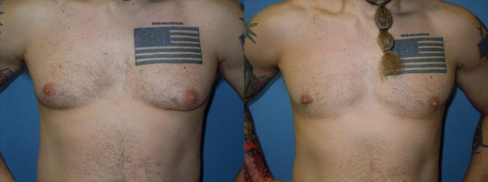 Before & After Liposuction - Male Chest Case 162 View #2 View in Coeur d'Alene, ID