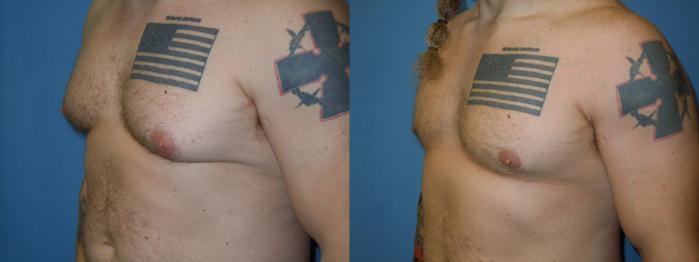 Before & After Liposuction - Male Chest Case 162 View #3 View in Coeur d'Alene, ID