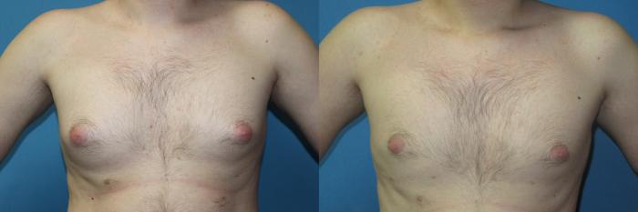 Before & After Liposuction - Male Chest Case 170 Front View in Coeur d'Alene, ID
