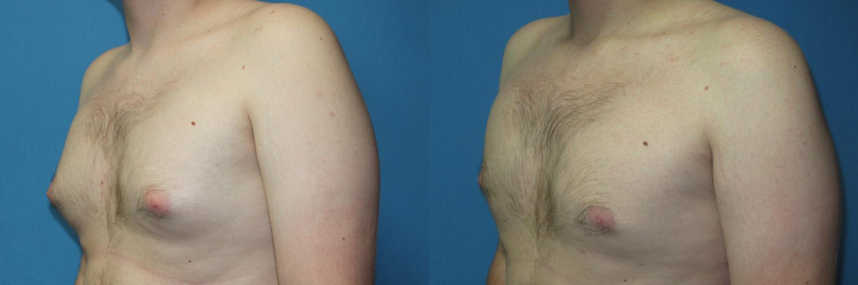Before & After Liposuction - Male Chest Case 170 Left Oblique View in Coeur d'Alene, ID