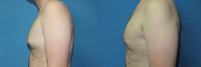 Before & After Liposuction - Male Chest Case 170 Left Side View in Coeur d'Alene, ID