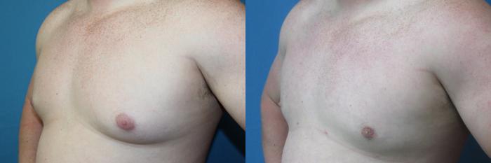 Before & After Liposuction - Male Chest Case 216 Left Oblique View in Coeur d'Alene, ID