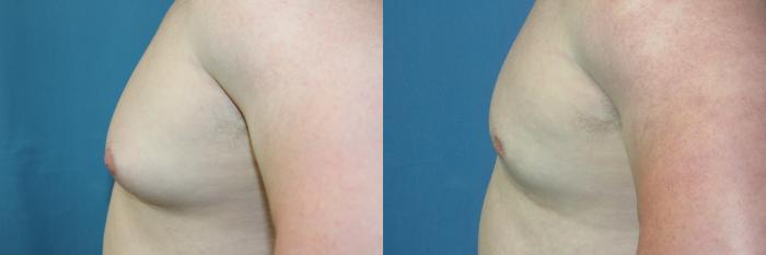 Before & After Liposuction - Male Chest Case 216 Left Side View in Coeur d'Alene, ID