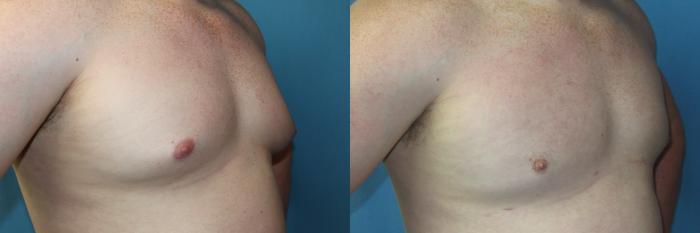 Before & After Liposuction - Male Chest Case 216 Right Oblique View in Coeur d'Alene, ID