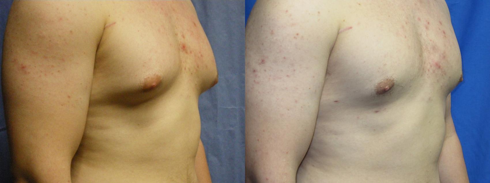 Liposuction - Male Chest Before and After Pictures Case 3