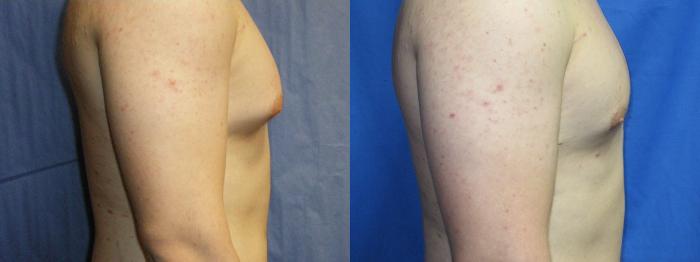 Before & After Liposuction - Male Chest Case 3 View #2 View in Coeur d'Alene, ID
