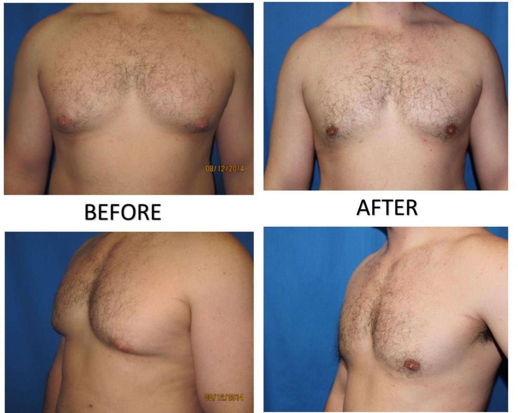 Before & After Liposuction - Male Chest Case 53 View #1 View in Coeur d'Alene, ID
