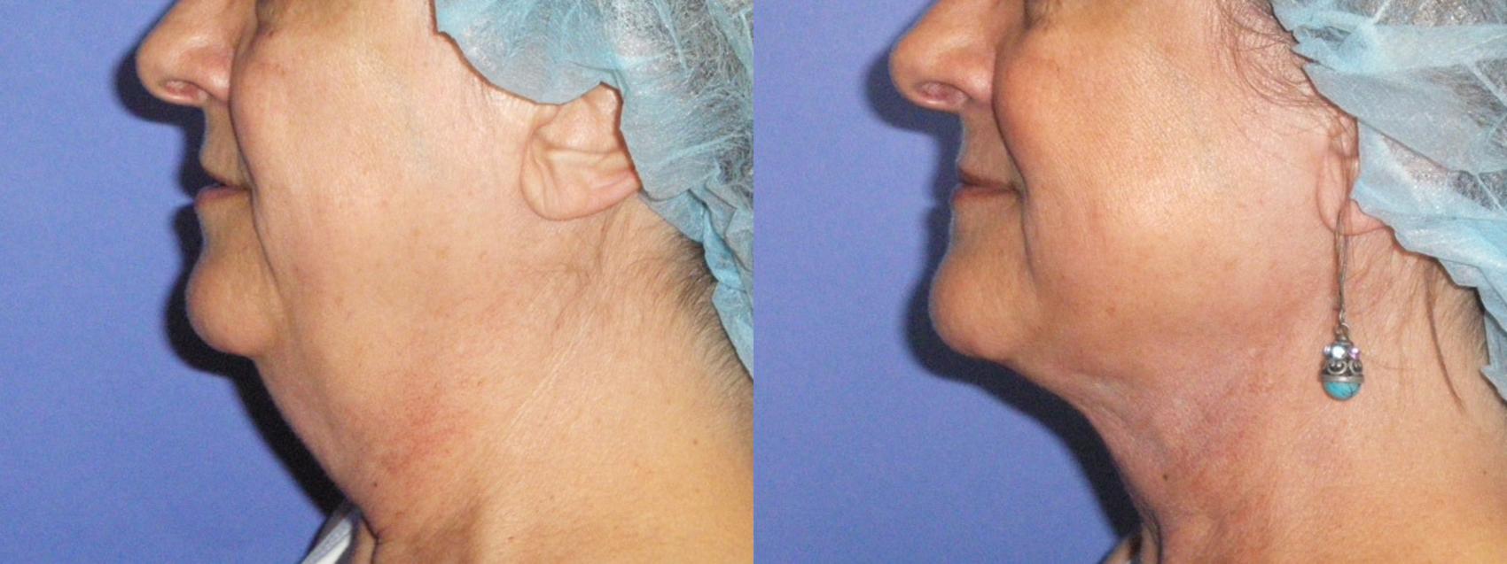 Before & After Liposuction - Neck / Precision TX Face & Neck Case 10 View #1 View in Coeur d'Alene, ID