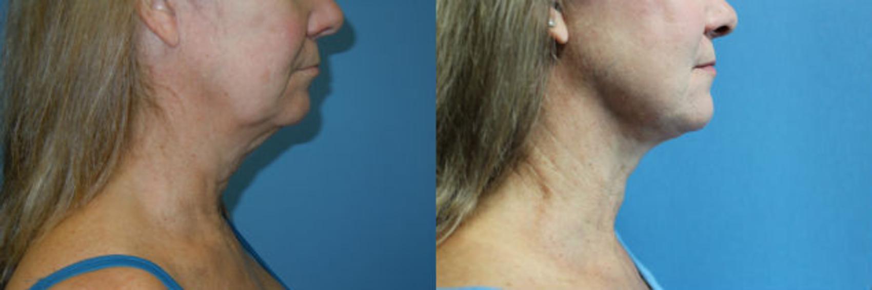 Before & After Liposuction - Neck / Precision TX Face & Neck Case 100 View #1 View in Coeur d'Alene, ID