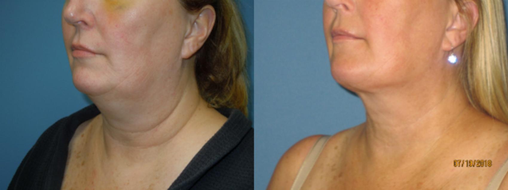 Before & After Liposuction - Neck / Precision TX Face & Neck Case 107 View #1 View in Coeur d'Alene, ID