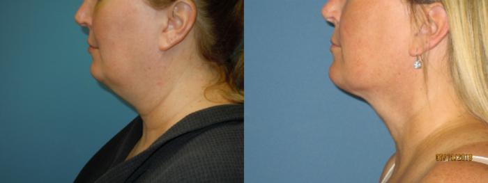 Before & After Liposuction - Neck / Precision TX Face & Neck Case 107 View #2 View in Coeur d'Alene, ID