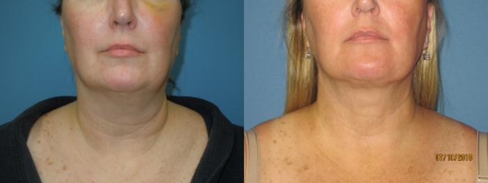 Before & After Liposuction - Neck / Precision TX Face & Neck Case 107 View #3 View in Coeur d'Alene, ID
