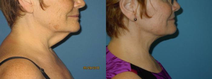 Before & After Liposuction - Neck / Precision TX Face & Neck Case 110 View #1 View in Coeur d'Alene, ID