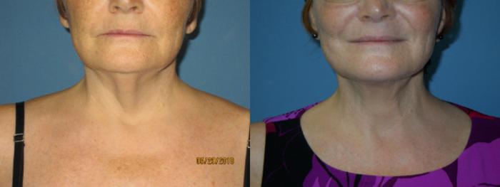 Before & After Liposuction - Neck / Precision TX Face & Neck Case 110 View #2 View in Coeur d'Alene, ID