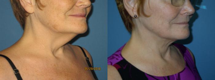 Before & After Liposuction - Neck / Precision TX Face & Neck Case 110 View #3 View in Coeur d'Alene, ID