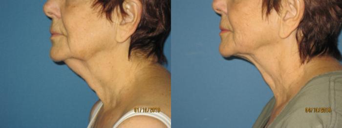 Before & After Liposuction - Neck / Precision TX Face & Neck Case 132 View #1 View in Coeur d'Alene, ID