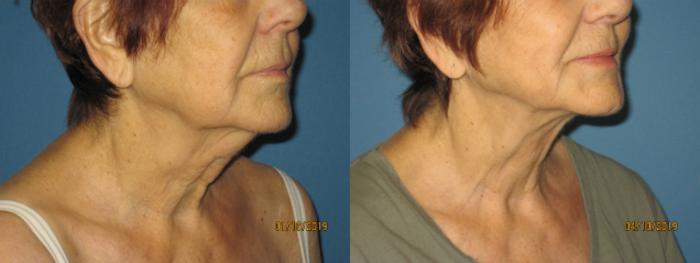 Before & After Liposuction - Neck / Precision TX Face & Neck Case 132 View #2 View in Coeur d'Alene, ID