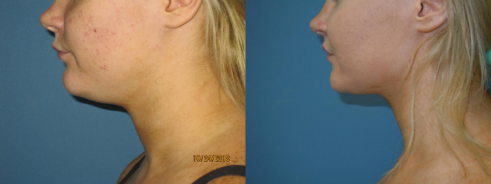 Before & After Liposuction - Neck / Precision TX Face & Neck Case 133 View #1 View in Coeur d'Alene, ID