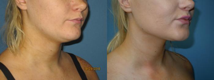 Before & After Liposuction - Neck / Precision TX Face & Neck Case 133 View #2 View in Coeur d'Alene, ID