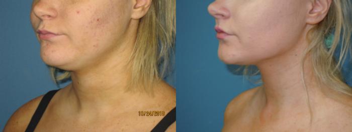 Before & After Liposuction - Neck / Precision TX Face & Neck Case 133 View #3 View in Coeur d'Alene, ID