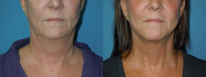 Before & After Liposuction - Neck / Precision TX Face & Neck Case 144 View #1 View in Coeur d'Alene, ID