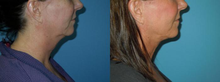 Before & After Liposuction - Neck / Precision TX Face & Neck Case 144 View #2 View in Coeur d'Alene, ID