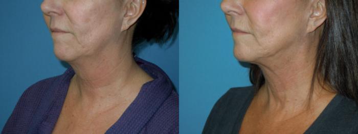 Before & After Liposuction - Neck / Precision TX Face & Neck Case 144 View #3 View in Coeur d'Alene, ID