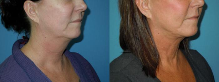 Before & After Liposuction - Neck / Precision TX Face & Neck Case 144 View #4 View in Coeur d'Alene, ID